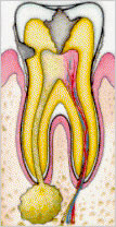 Põletikulise hamba läbilõige
